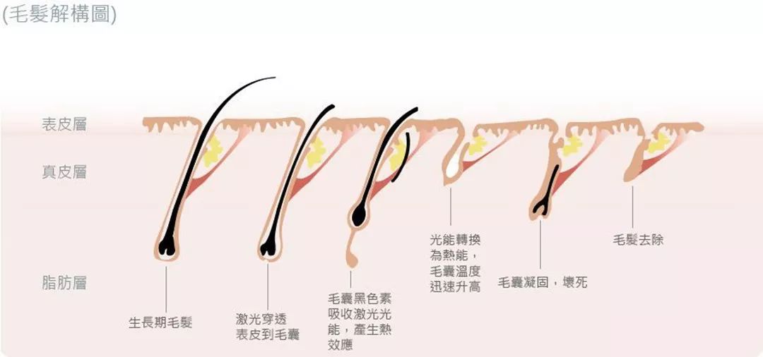 “白煮蛋”與“獼猴桃”之間，還差一個它 強脈沖脫毛器械，值得買嗎？